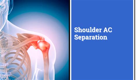 Shoulder Ac Separation Everything You Need To Know