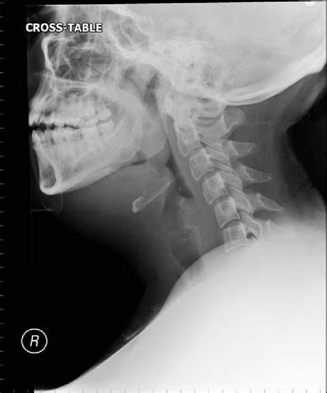 Plain Lateral Film Of The Neck Showing Soft Tissue Swelling And Gas