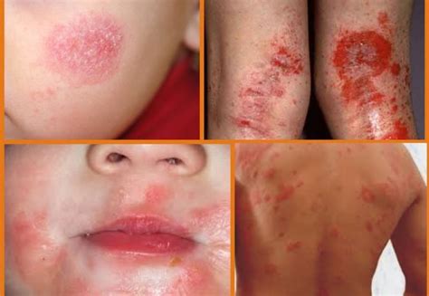 Dermatite At Pica No Rosto Causas Sintomas E Como Tratar The Sexiz Pix