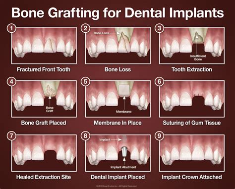 Bone Grafting For Dental Implants Sherway Gardens Dental Centre