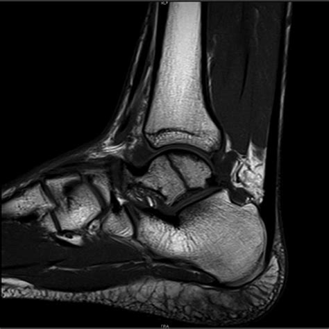 Coronal And Axial Ankle Mri Images Revealing A Non Displaced