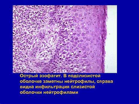 Острый эзофагит диета Болезни пищеварительной системы Болезни пищевода Болезни Болезни пищеварительной системы Болезни пищевода Болезни Острый эзофагит диета
