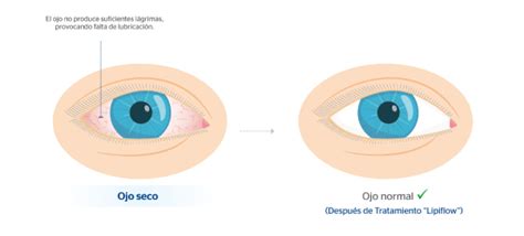 ojo seco qué es causas síntomas y tratamientos clínica baviera