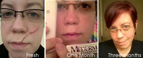 Covered In Crafts Mederma Scar Gel Quick Review