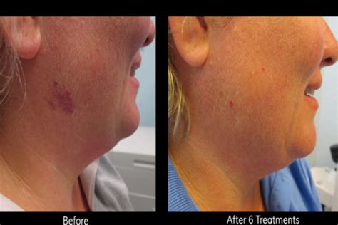 Laser Birthmark Removal Procedure Side Effects And Costs Before