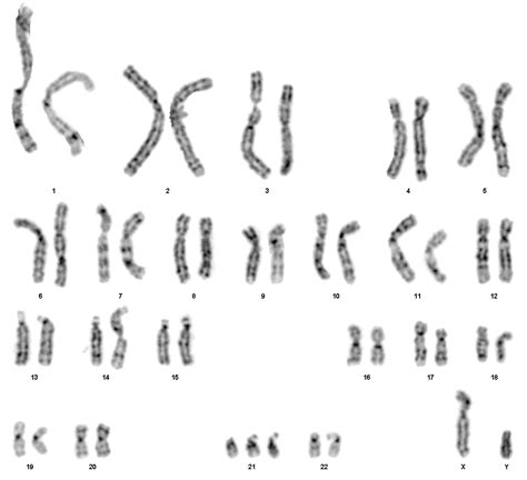 Chromosomal Diseases - Biochemistry - Medbullets Step 1