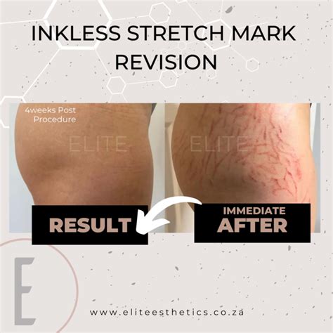 Inkless Stretch Mark And Scar Revision Elite Esthetics Beauty Training