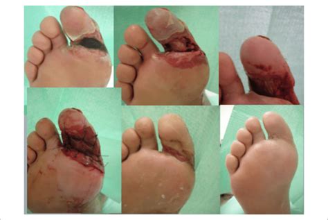 Ischemic Diabetic Foot Ulcer On The Plantar Region Of Right Allux Deep