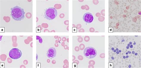 Malignant Cells Of Monocytic Lineage A E Large Monoblasts With Round