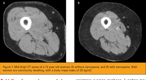 Sarcopenia is a type of muscle loss (muscle atrophy) that occurs with aging and/or immobility. Figure 1 from Sarcopenia--exercise as a treatment strategy ...