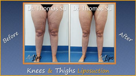 Lipo Legs Thigh Knee Liposuction Results Lipedema Surgery Expert Dr Thomas Su