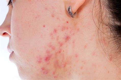 Butt Acne How To Deal With Pimples And Scars On Your Behind Huffpost