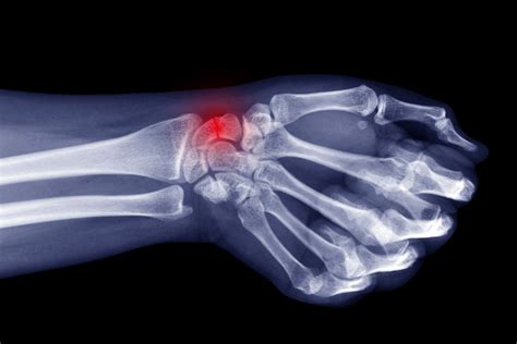 Wrist Fractures Treatment Casting Orthotics Plus Melbourne