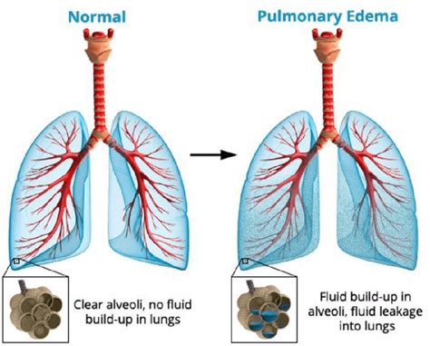 Lung Ultrasound Pulmonary Edema
