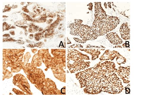 Cureus Skeletal Mets From Squamous Cell Carcinoma Of The Lower Limb