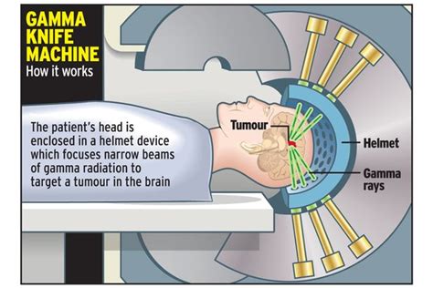 Gamma Knife For Avm Or Brain Tumor Treatment Getwellgo Indias Best