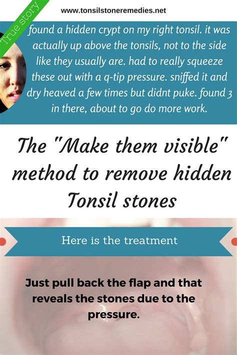 The Make Them Visible Method To Remove Hidden Tonsil Stone Flickr