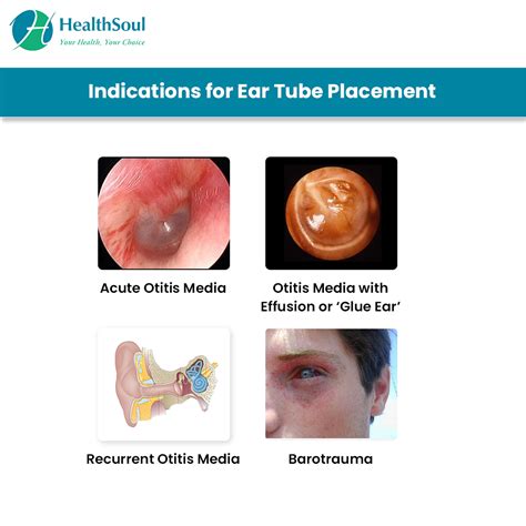 Ear Tube Placement Healthsoul