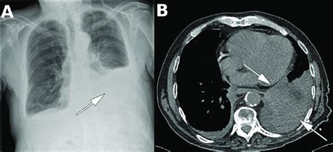 A The Chest X Ray Shows The Left Pleural Effusion B The Chest Ct