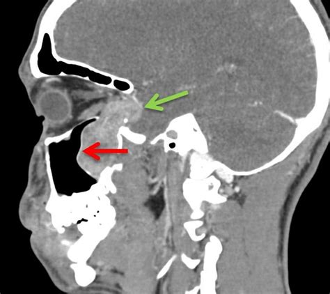Holman Miller Sign Juvenile Nasopharyngeal Angiofibroma Radiology