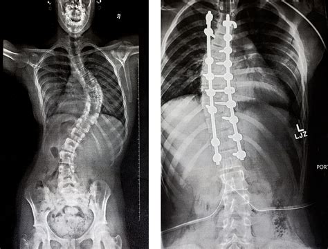 Powerful Photos Show Teen Girl Overcoming Idiopathic Scoliosis After