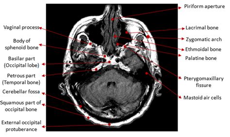 Ct Brain Image With Lobes And Fissure Download Scientific Diagram