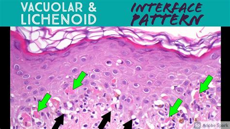 Vacuolar Vs Lichenoid Interface Dermatitis Pattern Inflammatory