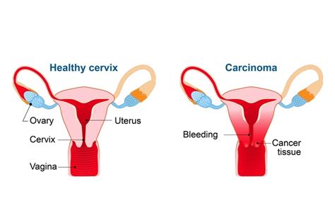 Hpv Test Cervical Cancer Screening And Hpv Vaccine Health Plus