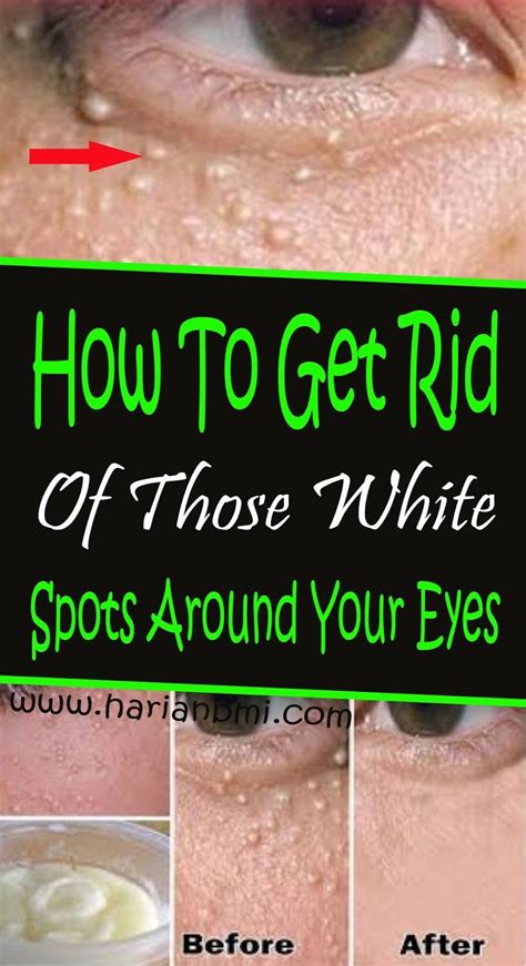 How To Get Rid Of Those White Spots Around Your Eyes Skin Cure How