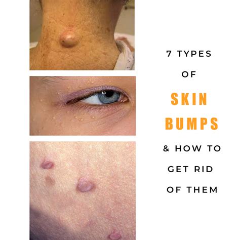7 Types Of Common Skin Bumps Causes And Treatments
