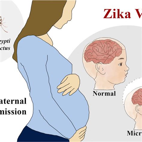 Zika Virus Associated Microcephaly When A Pregnant Woman Is Infected