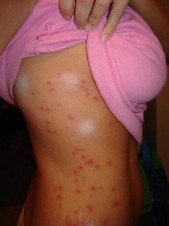 Rash From Hot Tubs Pictures Photos