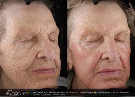 Laser Skin Resurfacing Co2 Facial Rejuvenation Advanced Dermatology