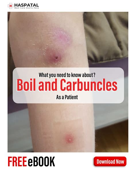 How Boils And Carbuncles Can Affect Your Body Haspatal Online