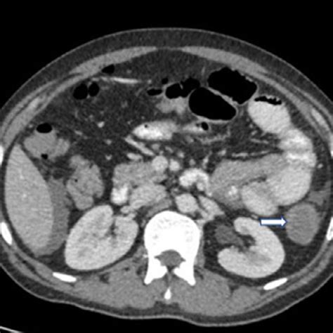On Axial Ct With Contrast Portal Venous Phase Hypo Enhancing