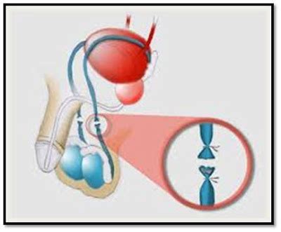 La vasectomia maschile è la resezione, dopo legatura, dei dotti deferenti (tubicini che collegano il testicolo alla prostata e permettono il passaggio degli spermatozoi). Asesoría psicológica Toka ®: Reversibilidad de la vasectomía