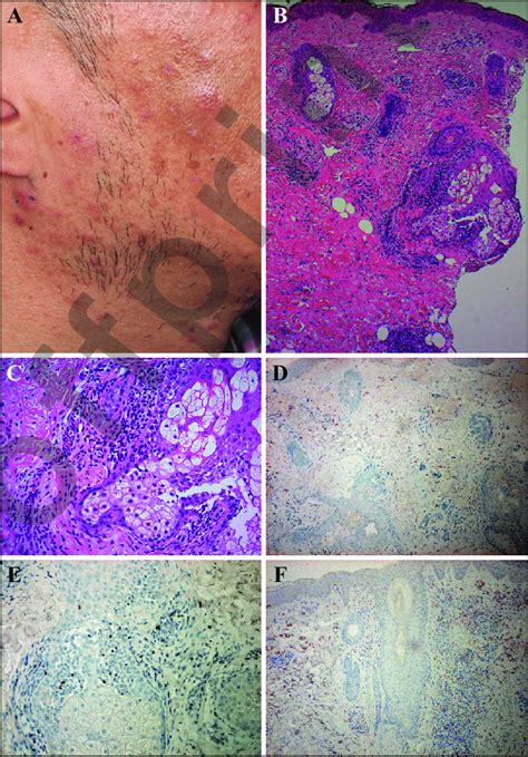 A Pruritic Indurated Erythematous Plaque With Papules And Pustules On