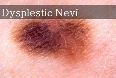 It is very dangerous if you don't treat it quickly. Different Types of Moles That You Must Know - Skin Disease ...
