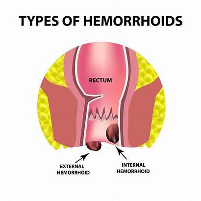 Internal Hemorrhoids Causes Blood External Rectum Stool