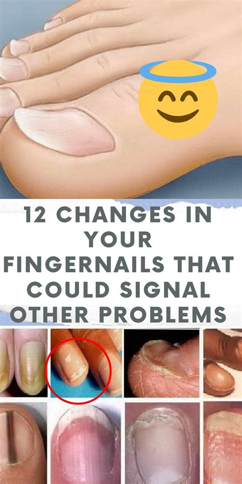 12 Changes In Your Fingernails That Could Signal Other Problems Viral