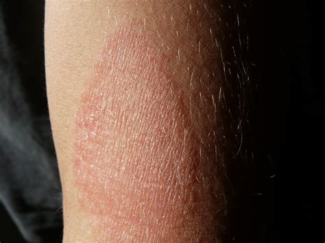 Discover The Most Common Eczema Myths And Find Out If They