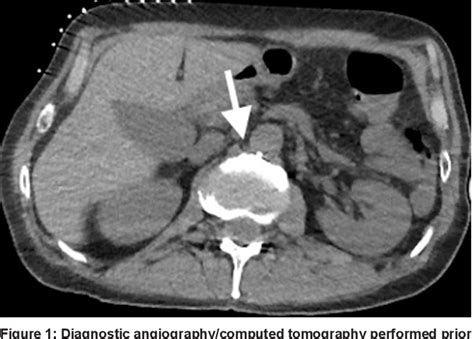 Figure 1 From Thoracic Duct Embolization Using Direct Hybrid