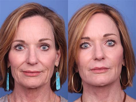 Facelift Before And After Pictures Case 155 Scottsdale Az Hobgood