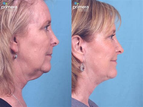 Neck And Face Liposuction Before And After Photos Patient 59 Orlando