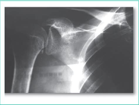 Figure 1 From Conservative Treatment Of Isolated Avulsion Fracture Of