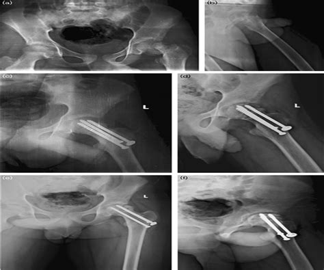 Bilateral Avascular Necrosis Of The Femoral Head Following A