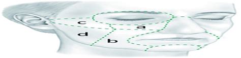 Anatomy Of The Cheek Implications For Soft Tissue Augmentat