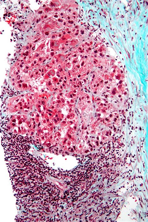 Hepatocellular Carcinoma Libre Pathology