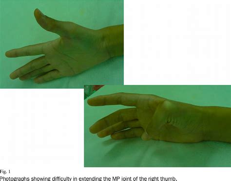 Figure From Reconstruction Of Extensor Tendon Dislocation Due To