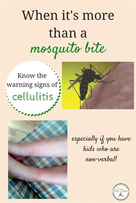 56 Best Of How To Treat Mosquito Bite Blisters Insectza